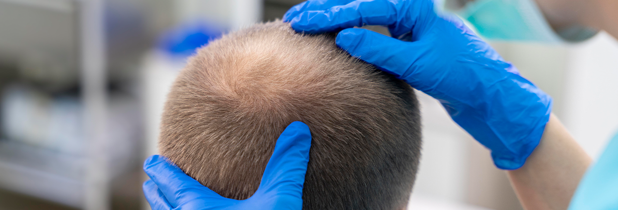 Does a Hair Transplant Hurt Saç Ekimi Sırasında Ağrı Hissedilir mi? İşlem Detayları