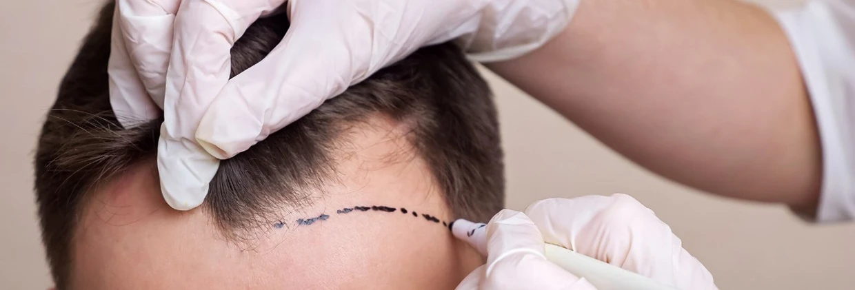 DHI Kalem Tekniği: Saç Ekiminde "El Sanatı" Devrimi The DHI Pen Technique