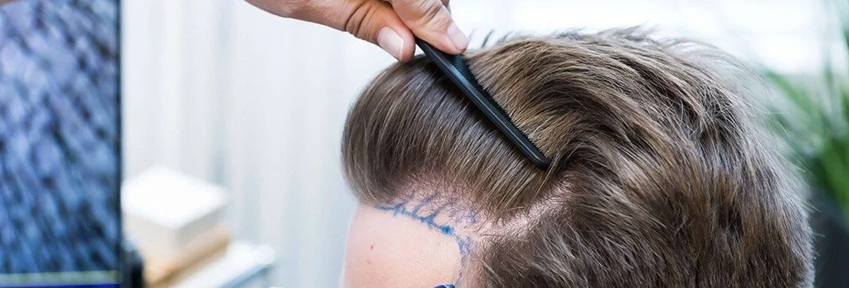 İyileşme Döneminde FUE Saç Ekimi: Saç Çizgisi Oluşumu ve İlk 3 Ay Rehberi FUE Hair Transplantation