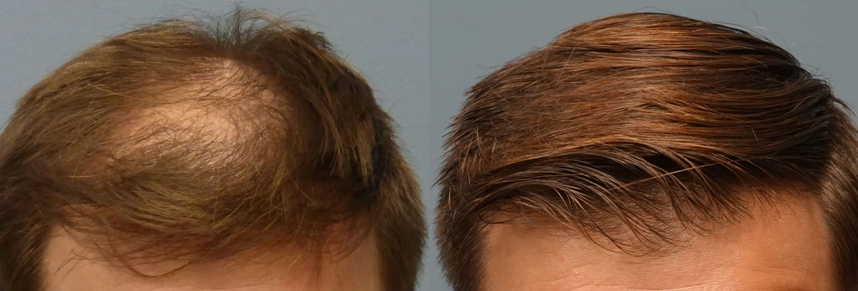 Saç Ekimi Sonrası Şok Dökülme: Ne Zaman Biter ve Sonrası Neler Olur? After Hair Transplantation