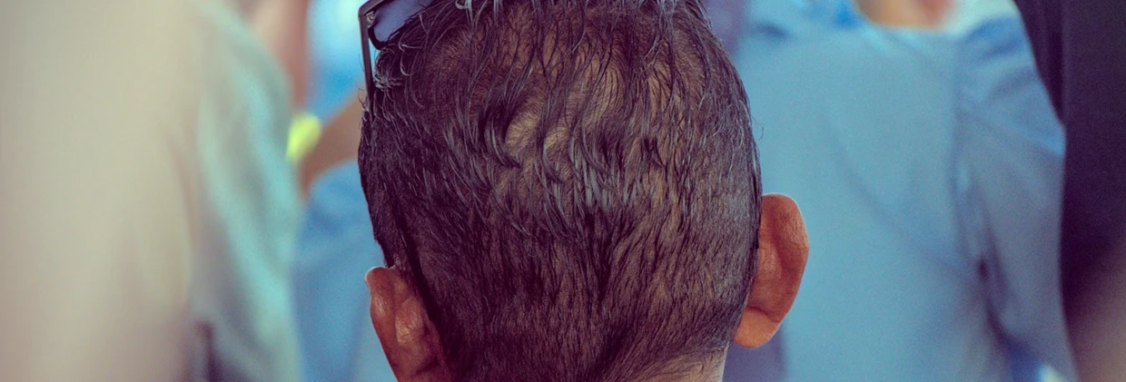 DHI Saç Ekimi Sonrası Hızlı Bakım Kılavuzu: En İyi Sonuç İçin Yapılacaklar DHI Hair Transplant Post-Op