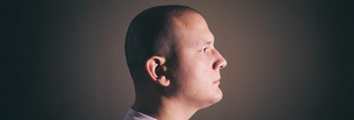 FUE ile Ekilen Saçlar Kalıcı mıdır? Gerçekler ve Efsaneler Hairs Transplanted with FUE Permanent?