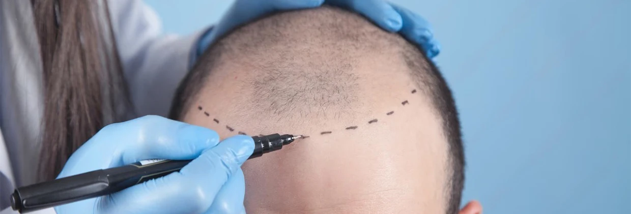 Saç ekimi Hair Transplantation