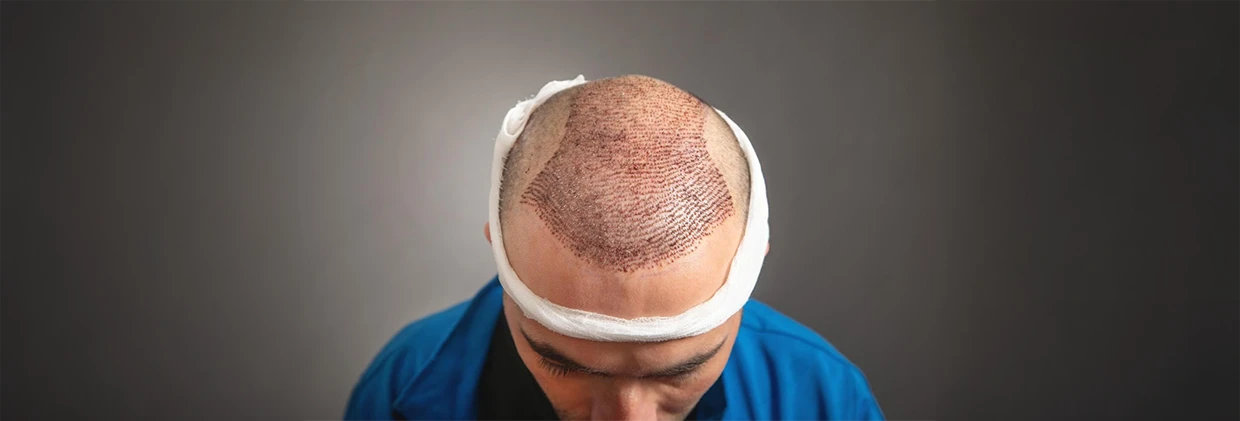 When Do Transplanted Hair Start to Grow? Ekilen Saçlar Ne Zaman Çıkar?