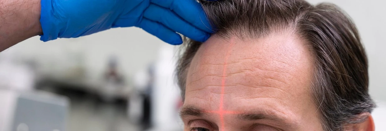 FUE Hair Transplant
