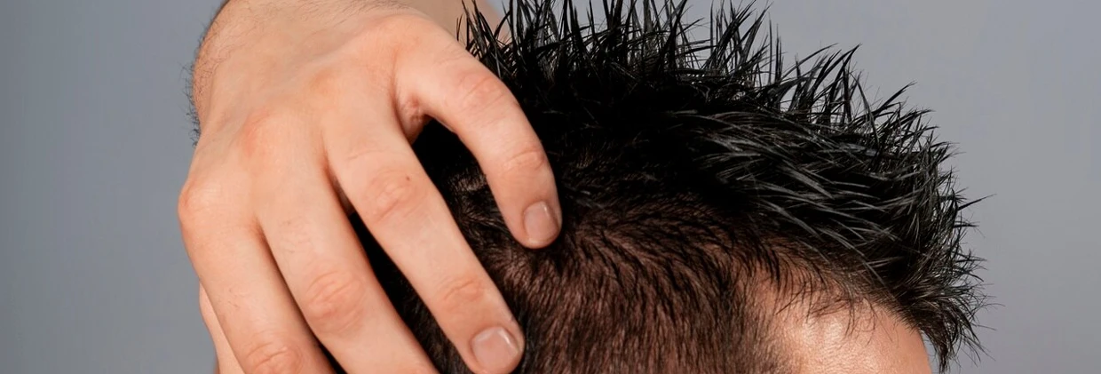 Hair Transplantation