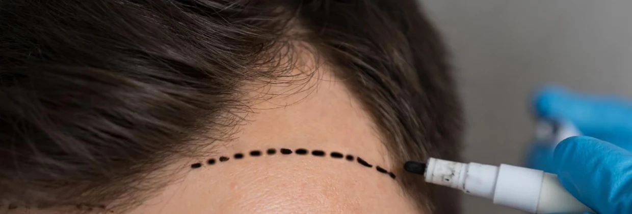 FUE Saç Ekimi Başarı Oranı: Neden Bazı Operasyonlar Daha Başarılı Olur? FUE Hair Transplant