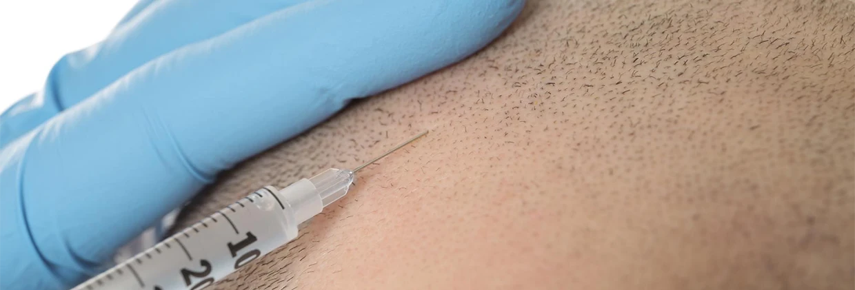 Kimler İçin DHI Saç Ekimi İdeal Bir Seçimdir? Who is DHI Hair Transplantation an Ideal Choice for?