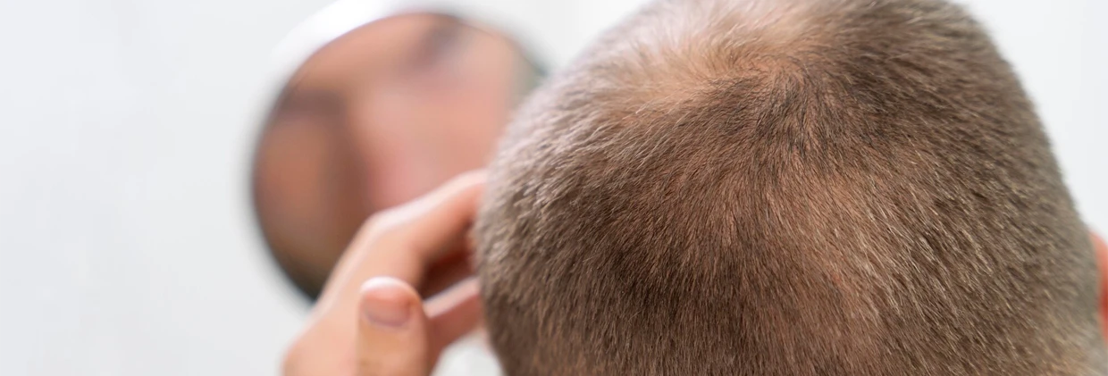 Yaşınıza Göre FUE Saç Ekimi: Genç ve İleri Yaşlarda Neler Farklılık Gösterir? FUE Hair Transplant by Age: What are the Differences in Young and Older Ages?