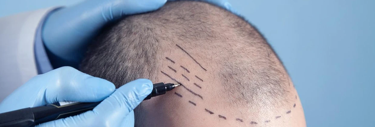 Doğrudan Saç Ekimi (DHI): Hızlı İyileşme ve Minimum Hasar Direct Hair Implantation