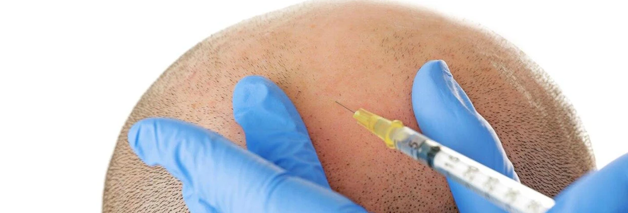 FUE Saç Ekimi Sonrası Seyahat Rehberi: Uçakta ve Tatilde Nelere Dikkat Etmeli? Post-FUE Hair Transplant Travel Guide