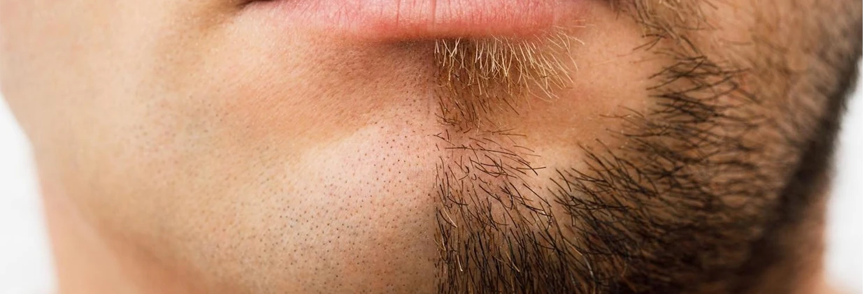 Sakal Ekimi ile Yüzünüzü Yeniden Şekillendirin: A'dan Z'ye Tam Kılavuz Reshape Your Face with Beard Transplantation: A Complete A-to-Z Guide