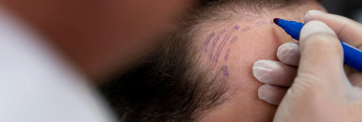 FUE Saç Ekimi Fiyatları: Hangi Faktörler Maliyeti Etkiler? FUE Hair Transplant Prices: What Factors Affect the Cost?