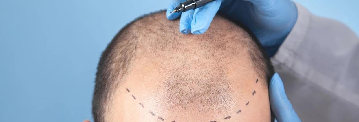 FUE Saç Ekimi Operasyonu Günü: Adım Adım Yaşayacaklarınız The Day of the FUE Hair Transplant Operation