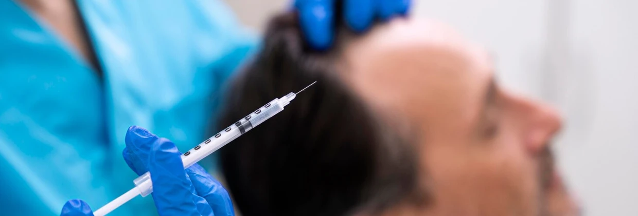 Saç Dökülmesi Tedavisinde Alternatif Yöntemler: Mezoterapinin Yeri Alternative Methods in Hair Loss Treatment: The Role of Mesotherapy