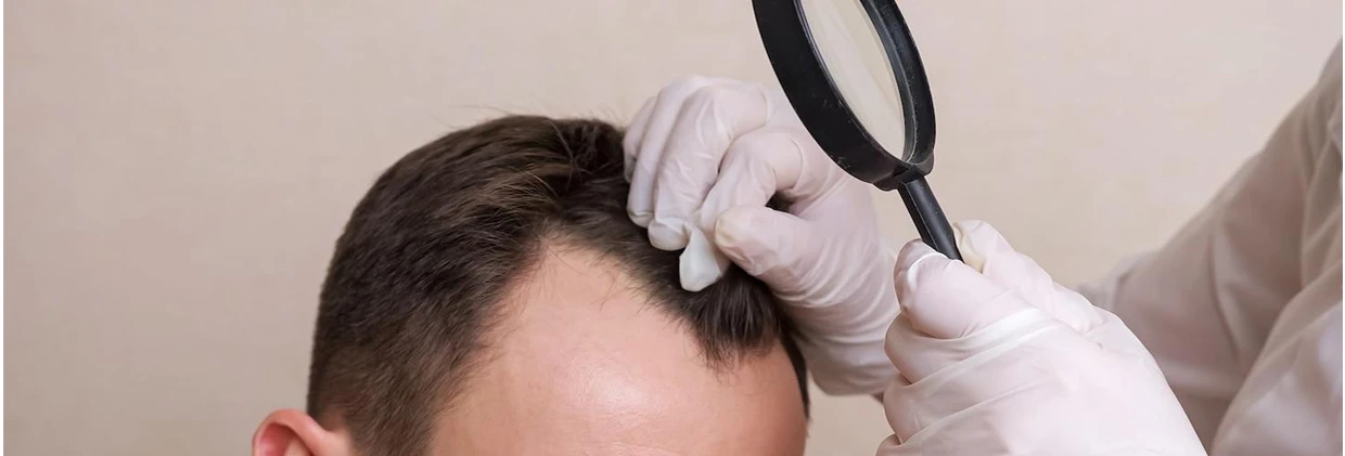 Saç Ekimi İçin Uygun Muyum? Hızlı Tarama Kontrol Listesi Am I Suitable for a Hair Transplant?